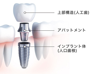 インプラントとは