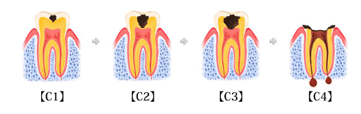 虫歯の進行