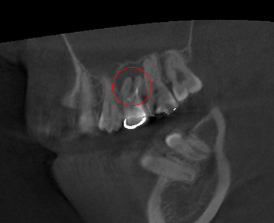 特徴2　 「見えない」ものを「見える化」させた「歯科用CT（3次元立体画像）」