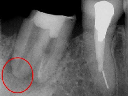 根管治療破折ファイル術後