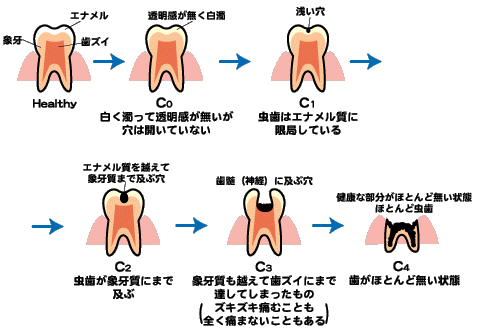 虫歯はいろいろ 大阪で根管治療なら クレモト歯科なんば診療所